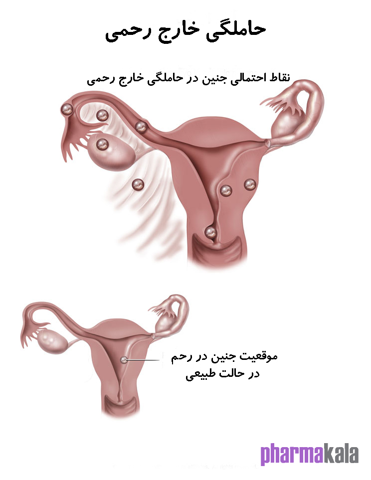 بارداری خارج از رحم چیست؟ بارداری خارج از رحم