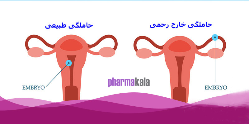 بارداری خارج از رحم چیست؟ عکس بارداری خارج از رحم