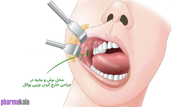 بوکال فت 