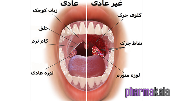 لوزه سوم (تورم لوزه) لوزه سوم (تورم لوزه)