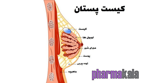 کیست سینه