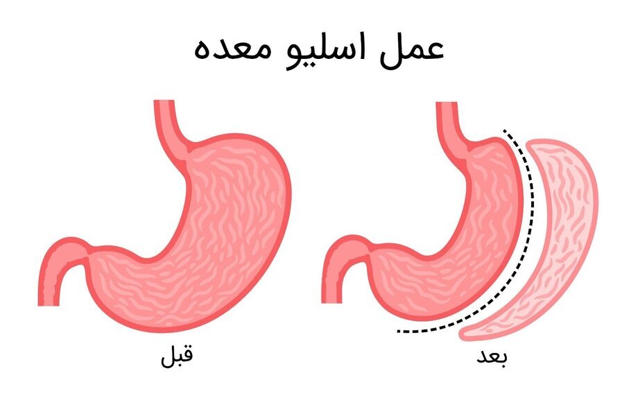 عمل اسلیو معده
