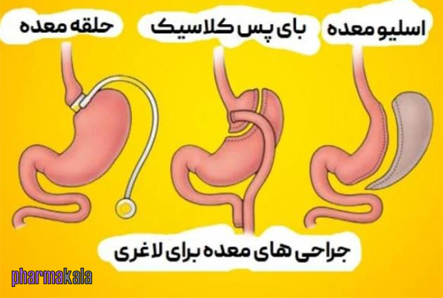 انواع جراحی های لاغری معده