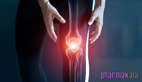 همه چیز در مورد آرتروز