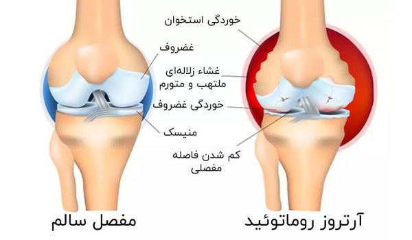 همه چیز در مورد آرتروز