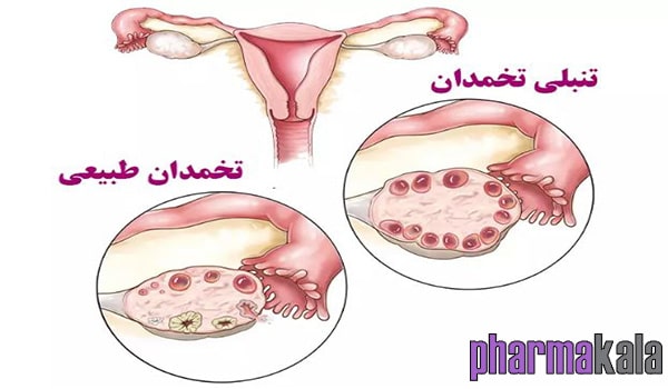 بهترین قرص برای تنبلی تخمدان