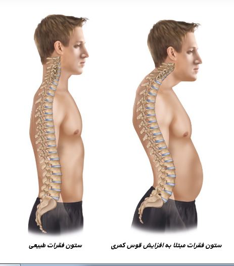 معرفی 5 روش رفع گودی کمر رفع گودی کمر