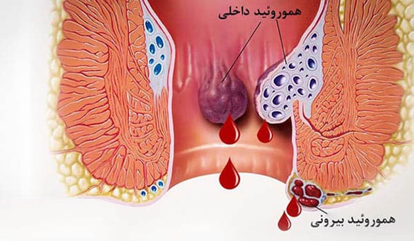درمان بواسیر درمان بواسیر