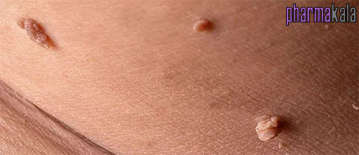 اچ پی وی (HPV) چیست؟ اچ پی وی (HPV) چیست؟