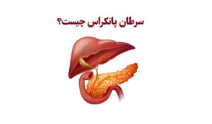 سرطان پانکراس چیست؟