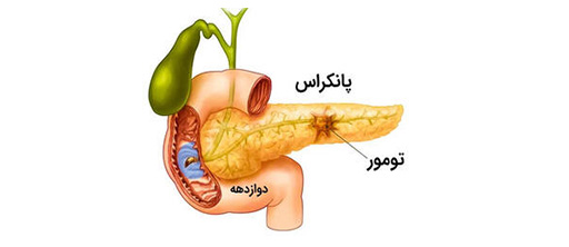سرطان پانکراس چیست؟
