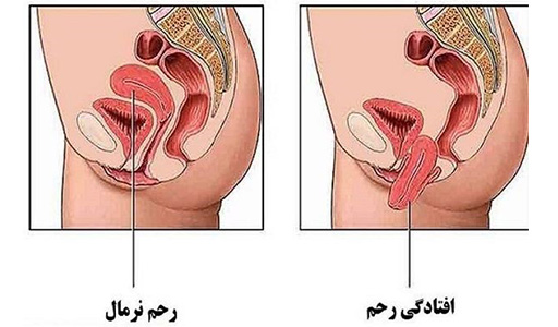 6 درمان افتادگی رحم درمان افتادگی رحم