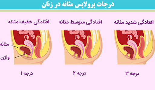 6 درمان افتادگی مثانه 5 درمان افتادگی مثانه