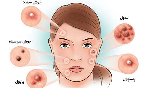 از بین بردن جوش صورت در یک روز | ۷ روش فوری فارماکالا ۲۰۲۶ از بین بردن جوش صورت در یک روز