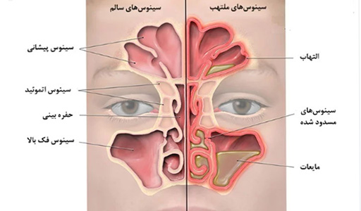 درمان فوری سینوزیت