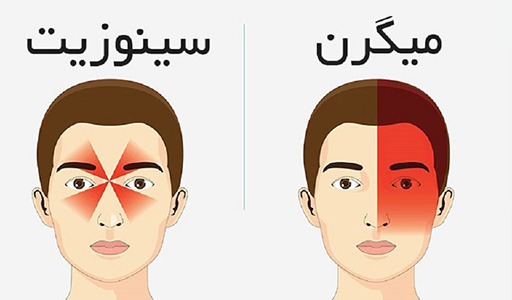 درمان فوری سینوزیت