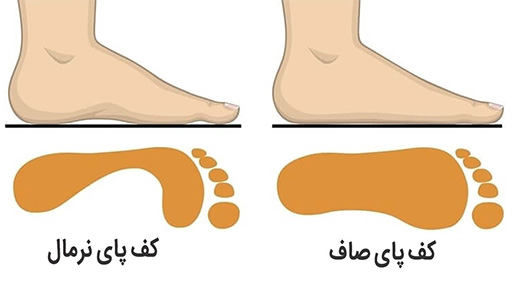 5 درمان صافی کف پا 5 درمان صافی کف پا