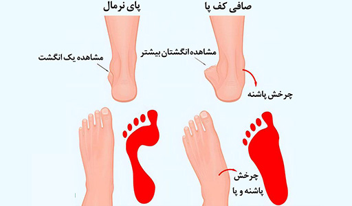 5 درمان صافی کف پا 5 درمان صافی کف پا