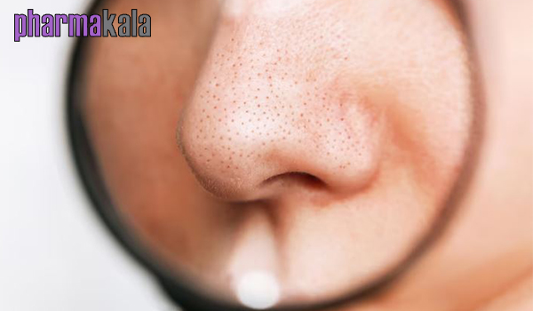 راه های کاهش منافذ باز پوست