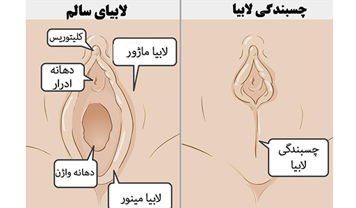 عکس چسبندگی لابیا کودک