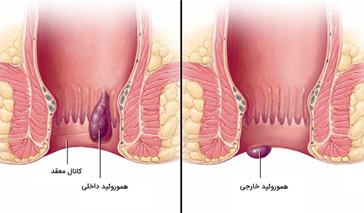 بهترین قرص برای درمان بواسیر