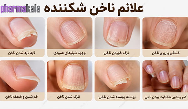علت شکنندگی ناخن چیست؟ 10 دلیل و بهترین روش تقویت ناخن شکننده چرا ناخنها شکننده میشوند؟