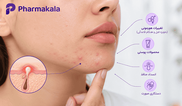 علت جوش زیر پوستی چیست؟ دلایل، درمان جوشهای ریز و سفت دردناک علت جوش زیر پوستی
