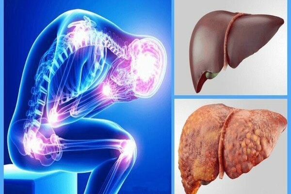 خواص کنگر فرنگی برای صفرا و سلامت کبد موارد منع مصرف گیاه کنگر فرنگی